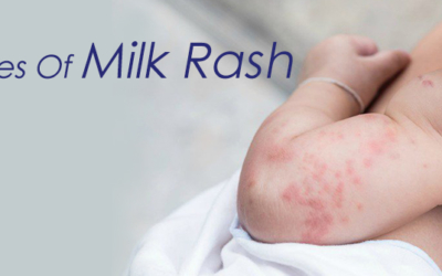 Causes of Milk Rash