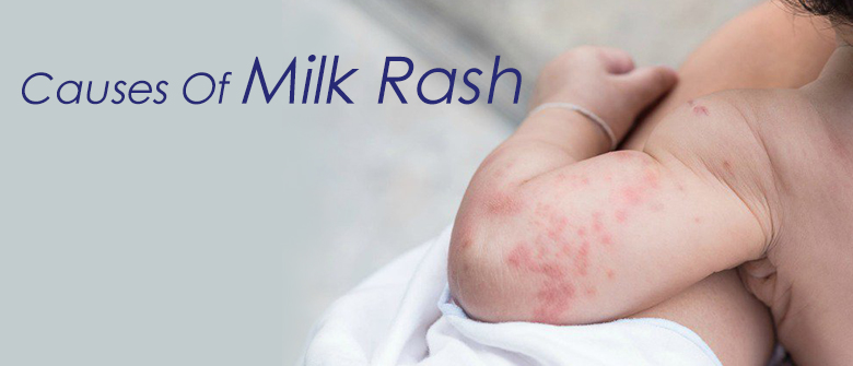 Causes of Milk Rash